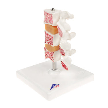 Modelo de Osteoporosis – Versión de Lujo (3 Vertebrales)