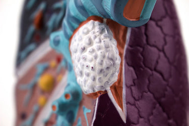 Modelo de Pulmón con Patología, Ampliado 1.5 Veces