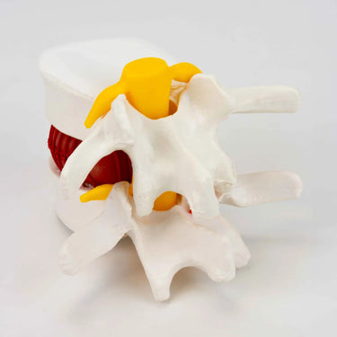 Modelo de Demostración de Disco Herniado