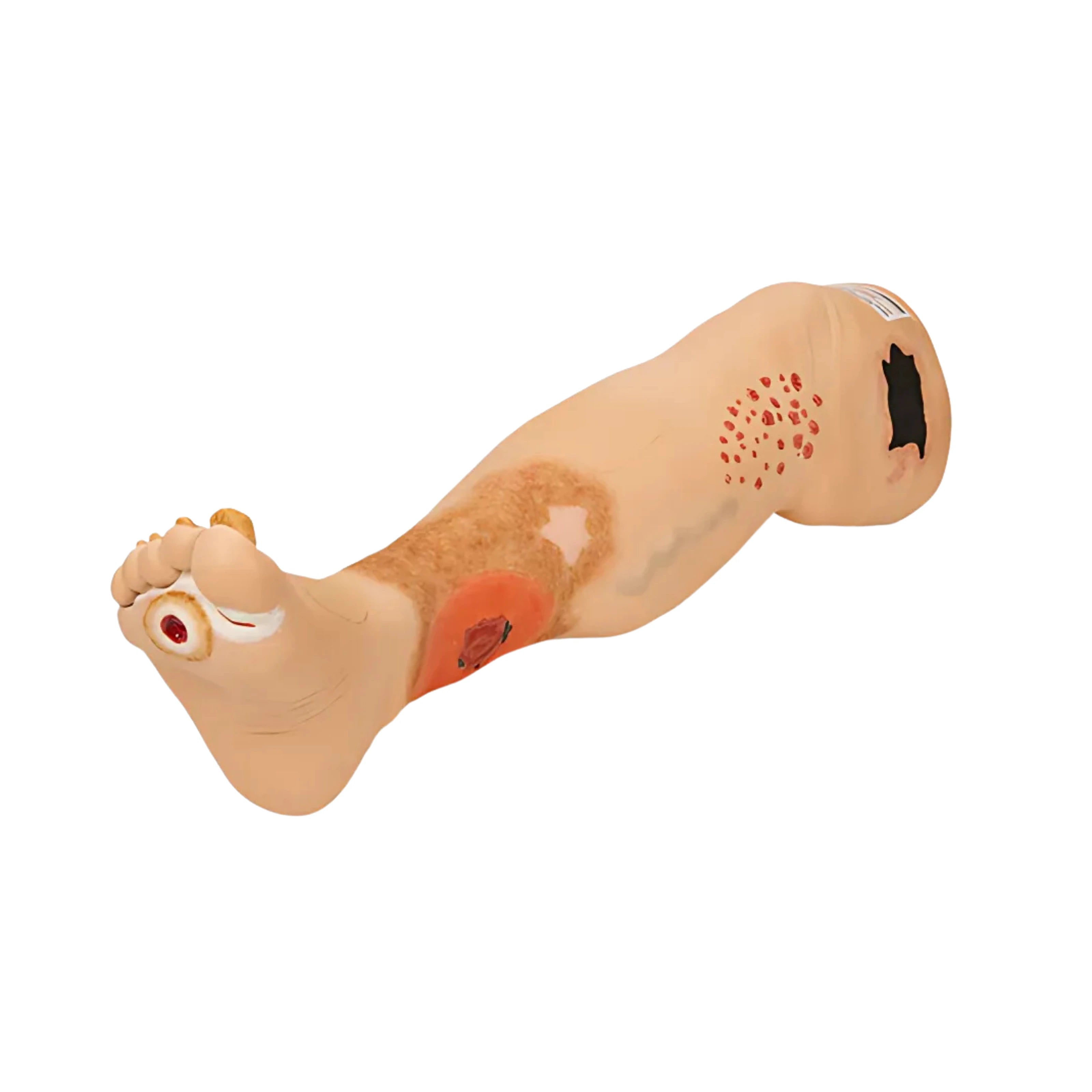 Pierna con Insuficiencia Venosa "Vinnie"