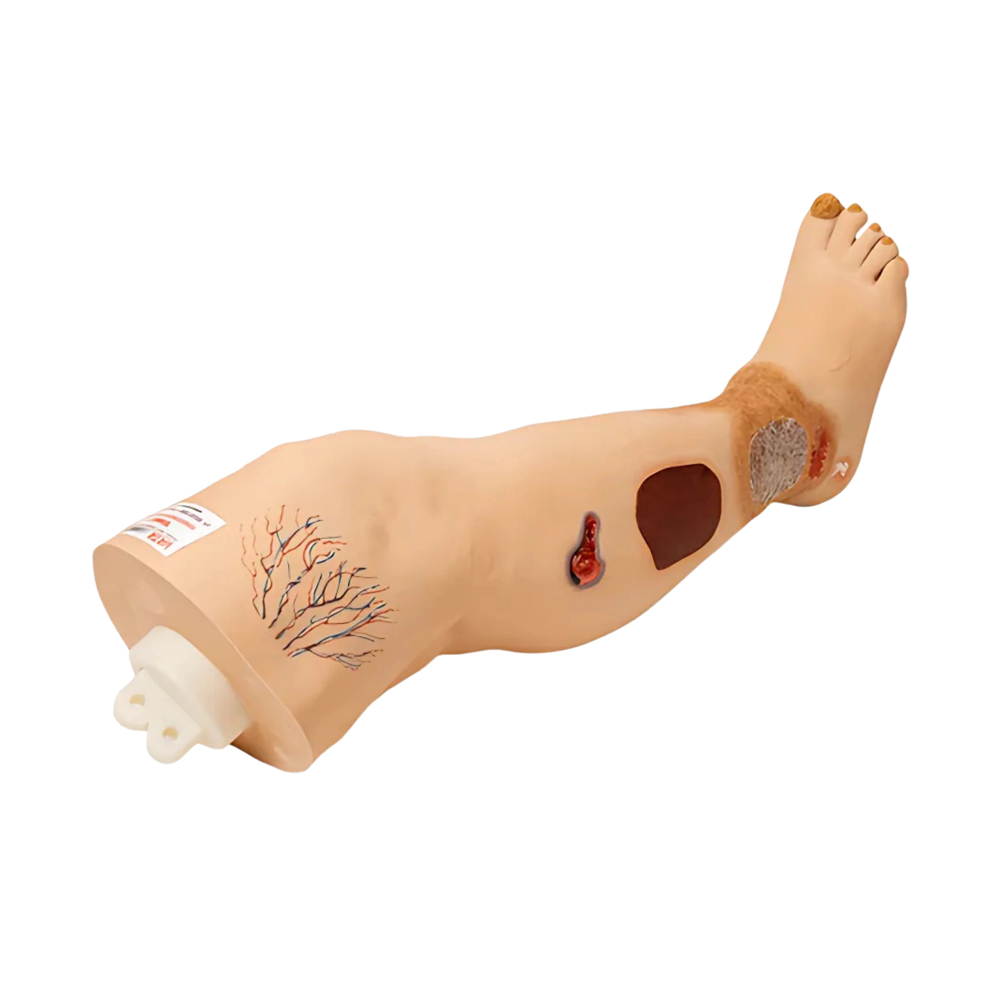 Pierna con Insuficiencia Venosa "Vinnie"