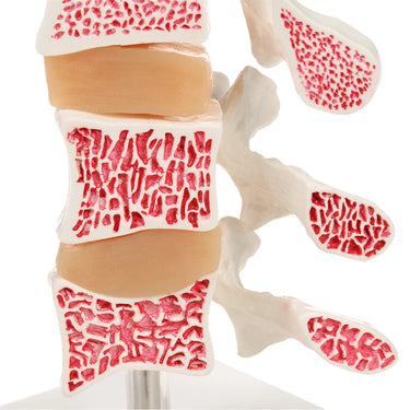 Modelo de Osteoporosis – Versión de Lujo (3 Vertebrales)