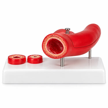 Modelo de Arteriosclerosis con Sección Transversa de la Arteria, 2 Piezas