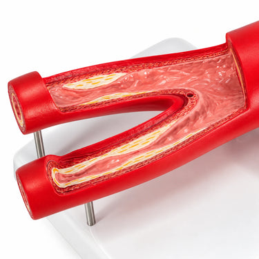 Modelo de Arteriosclerosis con Sección Transversa de la Arteria, 2 Piezas