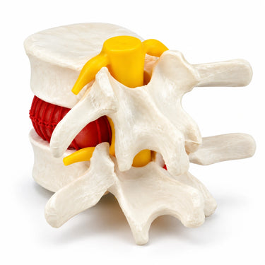 Modelo de Demostración de Disco Herniado