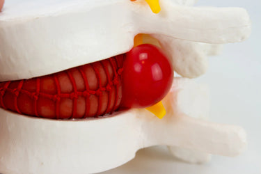 Modelo de Demostración de Disco Herniado